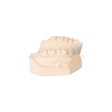 Restorative Porcelain Crowns for Dental Implants